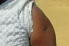 La balle des islamistes a laissé des traces sur le bras d’Aishafu. (csi)